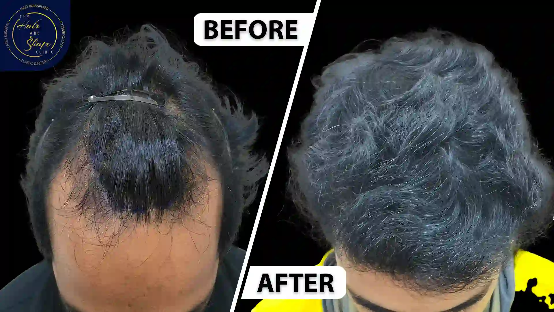 Hair Transplant result11